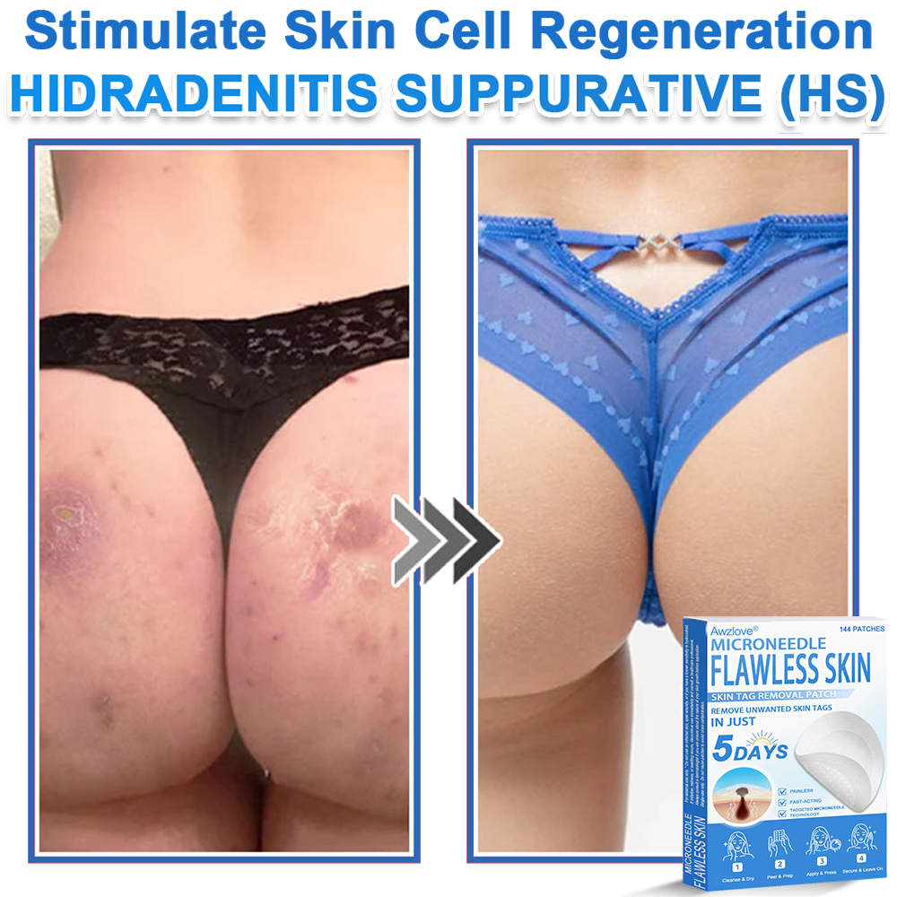 📌 Awzlove® 2-in-1 Microneedle & Hydrocolloid Patch | Raised Moles,Acne,  Flat Warts & Skin Tags Remover | Improves Wrinkles, Scars & Blemishes | Invisible Star Pimple Patches for Face & Body |🎁🎁2