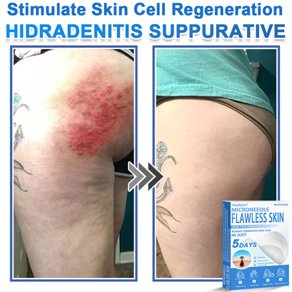📌 Awzlove® 2-in-1 Microneedle & Hydrocolloid Patch | Raised Moles,Acne,  Flat Warts & Skin Tags Remover | Improves Wrinkles, Scars & Blemishes | Invisible Star Pimple Patches for Face & Body |🎁🎁2